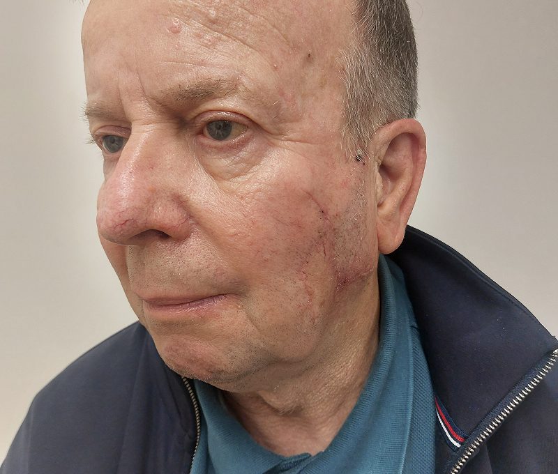 Skin tumour excision and reconstruction, after