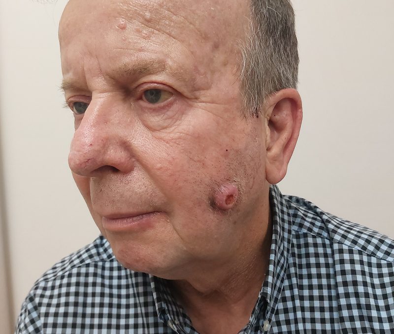 Skin tumour excision and reconstruction, before