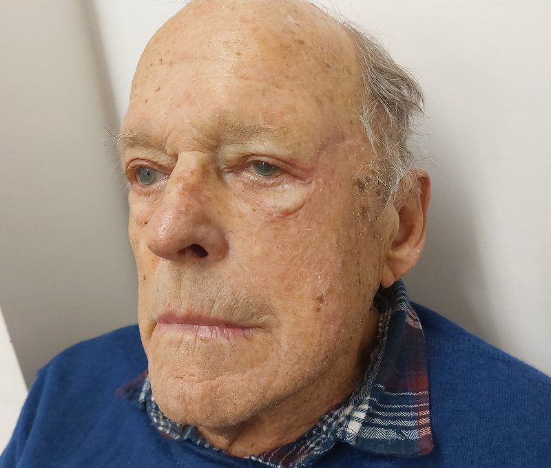 Skin tumour excision with bilateral upper blepharoplasty, after