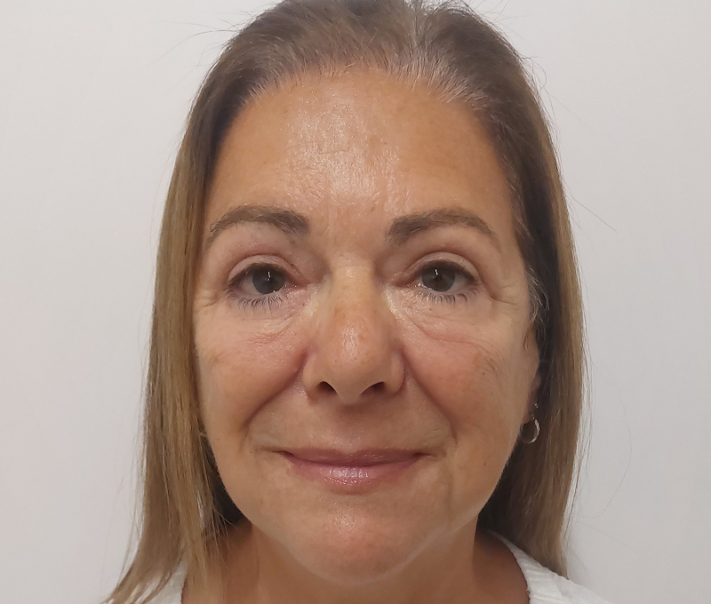 Upper and lower lid blepharoplasty · Patient two, after
