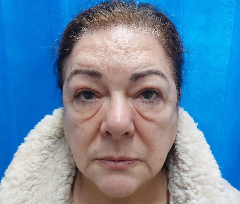 Upper and lower lid blepharoplasty · Patient two, before
